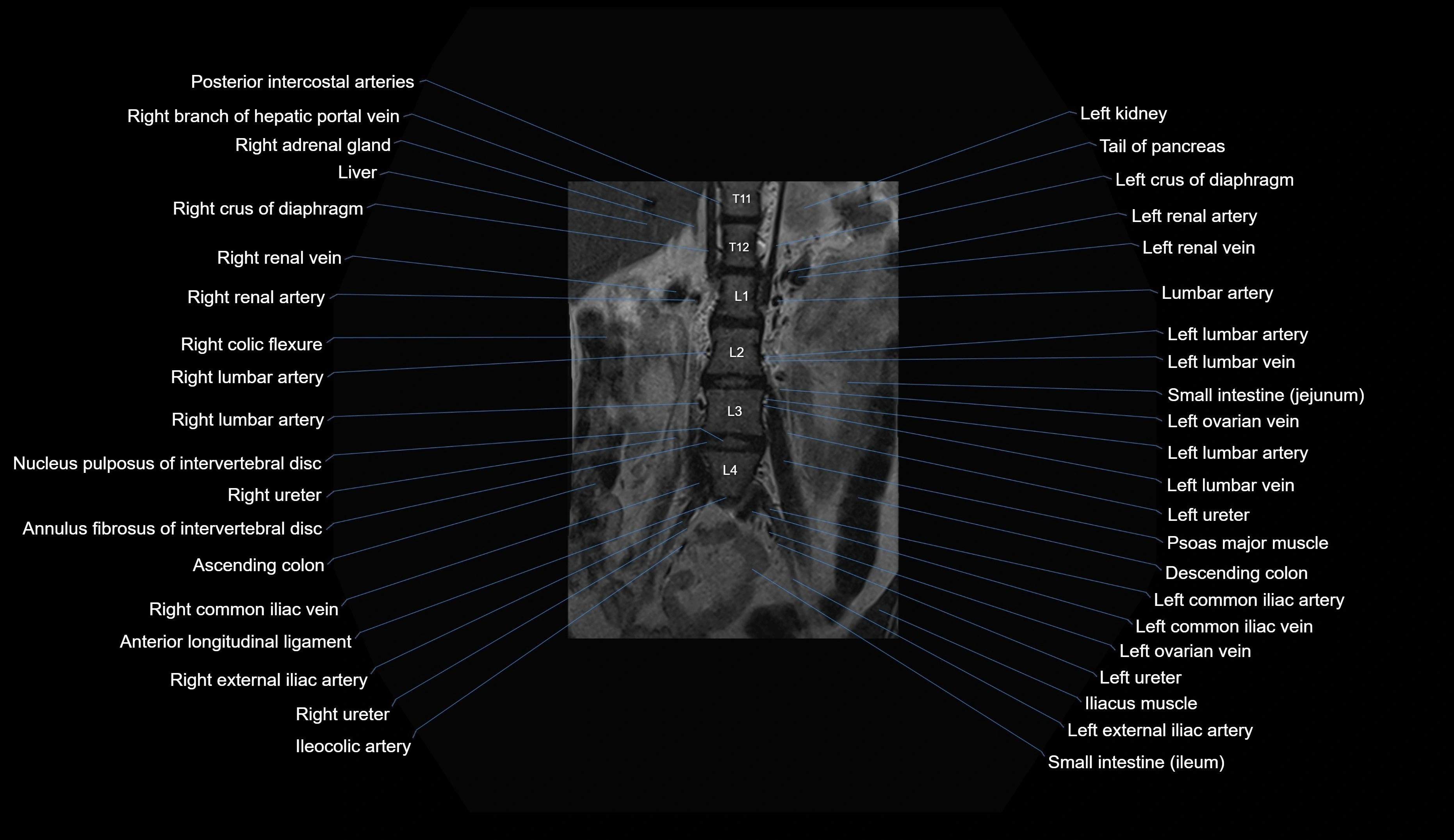 MRI lumbar spine coronal cross sectional anatomy 3T radiology  image-img-00001-00006.webp